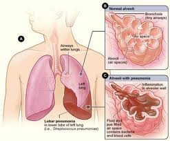 cara mengobati radang paru-paru